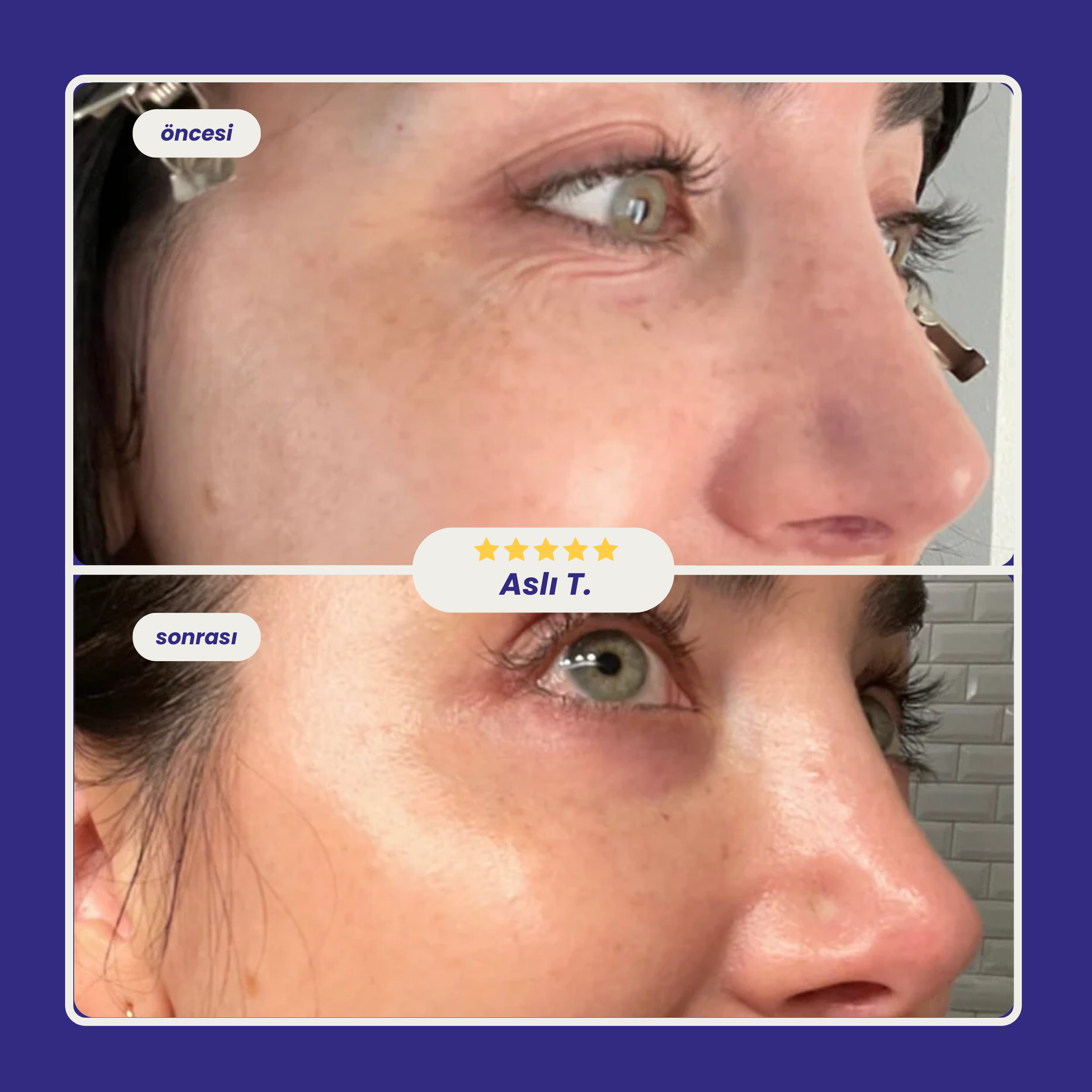 Solye© Kolajen Bant