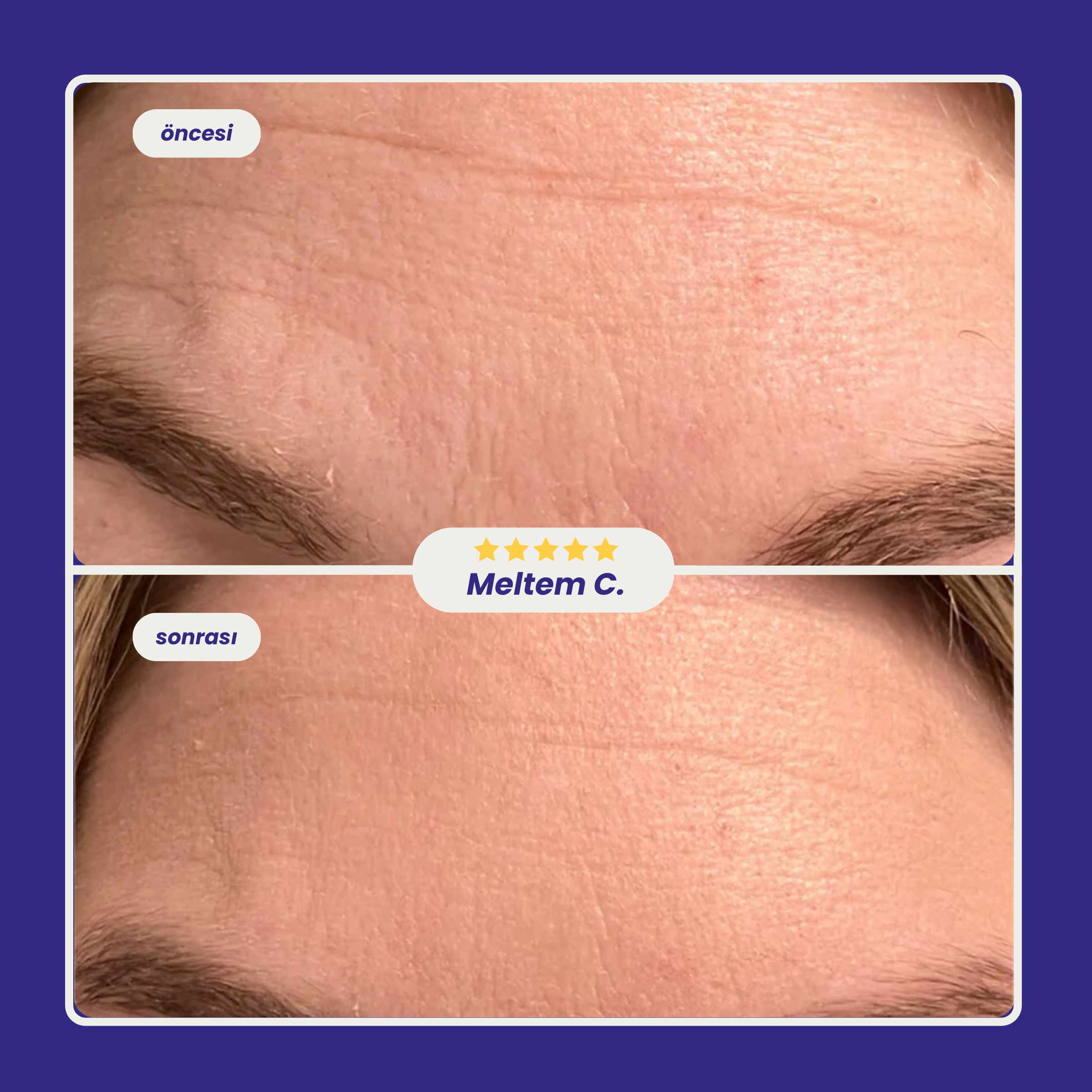 Solye© Kolajen Bant